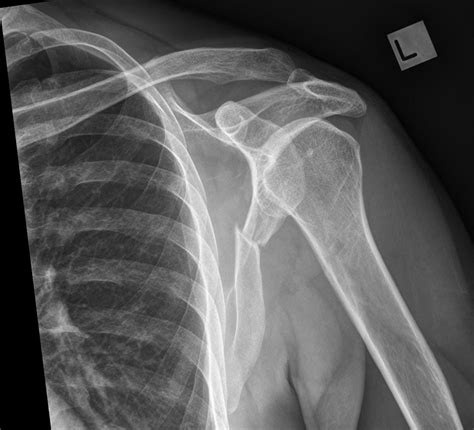 How To Read Shoulder Joint Fracture X Ray Scapula Fracture Xray | The Best Porn Website