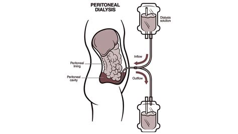 Easy and affordable access to Peritoneal Dialysis under PMNDP facilitates ‘Living well with ...