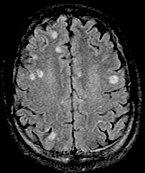 Toxoplasma gondii and Schizophrenia - microbewiki