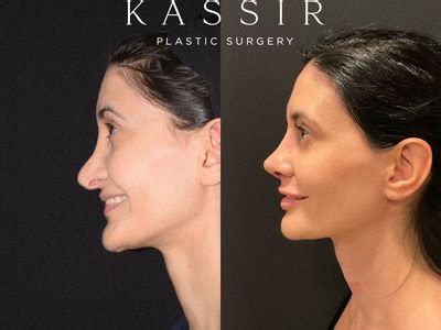 Best Revision Rhinoplasty Surgeon New York — Kassir Plastic Surgery in NY and NJ