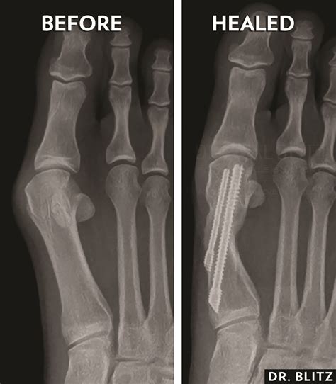 Current Concepts In Minimally Invasive Bunion Surgery