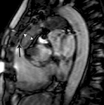 TGA in 25‐year‐old woman with prior Rastelli repair. MR imaging was... | Download Scientific Diagram