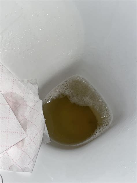 foamy urine? : r/KidneyStones