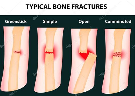 Typical bone fractures — Stock Vector © edesignua #14262625