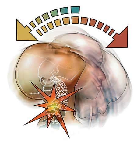 Cervical Spine Sprain/Strain – Dr. Russell D. Caram Chiropractic Physician