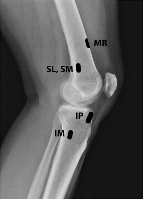 Fluoroscopic Guided Knee Genicular Nerve Block - Technique and Overview - The Procedure Guide