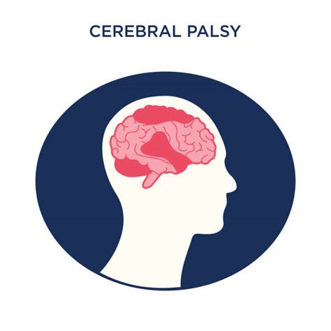 40+ Cerebral Palsy Care Illustrations, Royalty-Free Vector Graphics ...