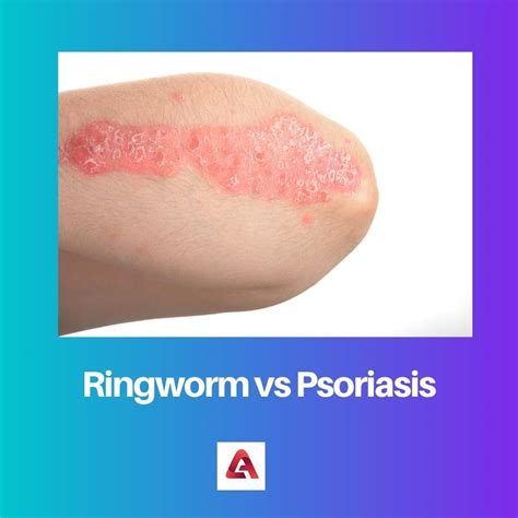 Ringworm vs Psoriasis: Difference and Comparison