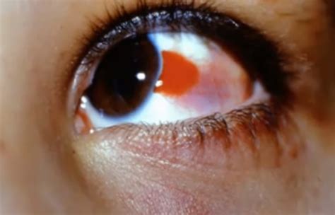 Burst blood vessel in eye – Symptoms, Causes, Treatment | HubPages