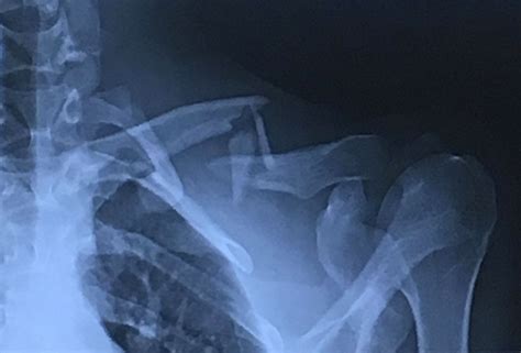 How to Deal With a Clavicle Fracture (Broken Collarbone) | LaptrinhX / News