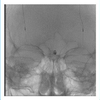 Patient 4: 3-dimensional reconstruction cerebral angiogram, right... | Download Scientific Diagram