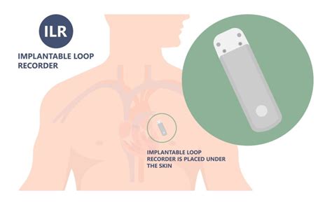 Decoding Implantable Loop Recorders: A Comprehensive Guide - Longmore ...