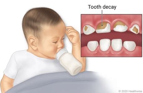 Baby Bottle Tooth Decay