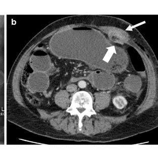 a Abdominal X-ray showing faecal loading but no signs of bowel... | Download Scientific Diagram