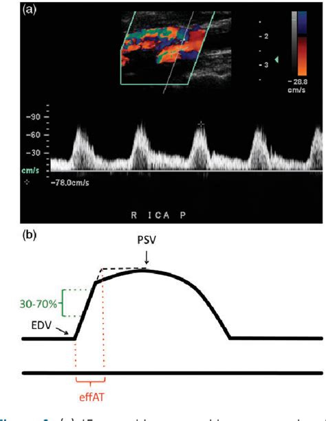 Figure 2 from Computer-assisted detection of tardus parvus waveforms on Doppler ultrasound ...