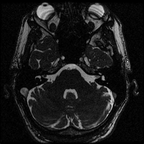 Acoustic neuroma MRI - wikidoc