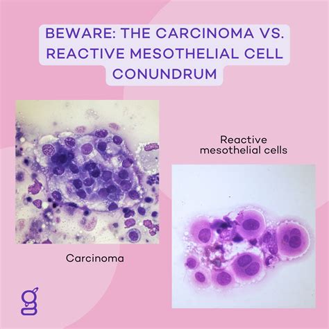 The Carcinoma vs. Reactive Mesothelial Cell Conundrum