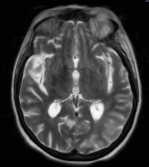 CMV encephalitis in an immune-competent patient | BMJ Case Reports