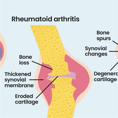 What Is Rheumatoid Arthritis? Rheumatoid Arthritis Explained | NRAS