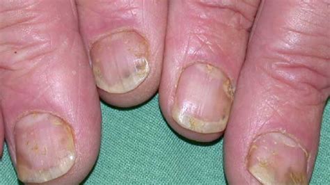 Nail Psoriasis: Pictures, Symptoms, and Treatments