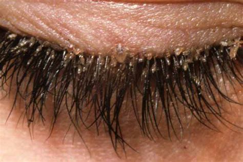 Eyelash(Demodex) Mites-Pictures on Dogs, Human Scalp, Face & How to get Rid | Pestbugs