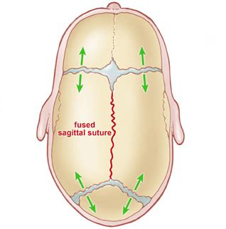 Skull Anomaly (Craniosynostosis) | OHSU