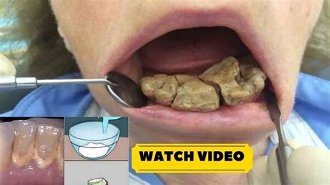 How To Get Rid Of Plaque On Dogs Teeth
