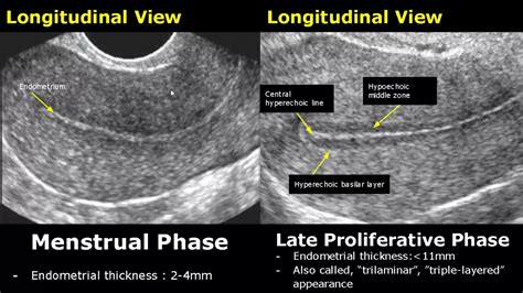 Understanding The Ideal Thickness Of Uterine Lining For Successful IVF ...