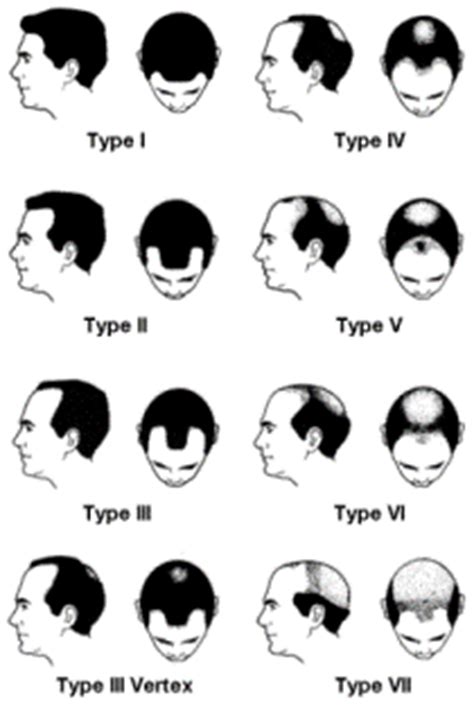 Receding Hairline Stages - Page 2