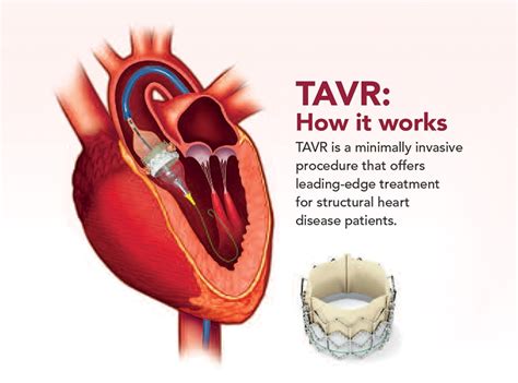 Understanding heart surgery. - St. Clair Health