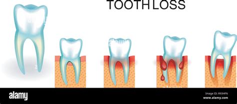 Bleeding gums hi-res stock photography and images - Alamy