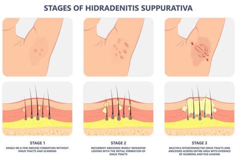 Hidradenitis Suppurativa Stages: Symptoms, Progression, And, 42% OFF