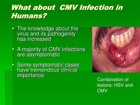 PPT - Perinatal CMV Infection PowerPoint Presentation, free download ...