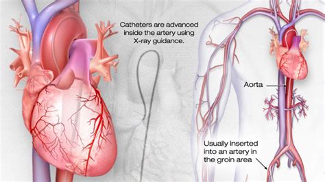 Donald Lepp...My World: Cardiac Transplant - Heart Catheterization