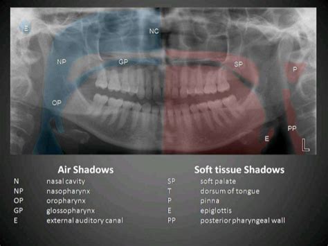 Radiographic interpretation