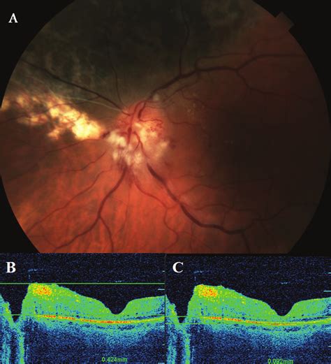 (A) Color fundus photograph showing characteristic optic disc edema ...