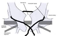 Cervical Insufficiency Treatment & Management: Cervical Cerclage, Progesterone Supplementation ...