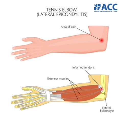 Elbow pain: Types and Treatments | ACC