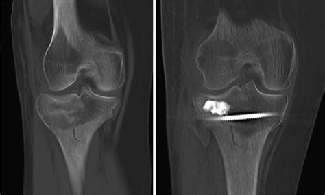 Reduction of the fracture (preoperative versus postoperative, computed... | Download Scientific ...