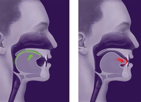 17 Best images about Tongue Thrust on Pinterest | Therapy, Sleep therapy and Stick it