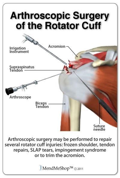 Physical Therapy After Rotator Cuff Impingement Repair