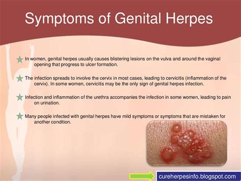 Genital Herpes Symptoms - Bing images