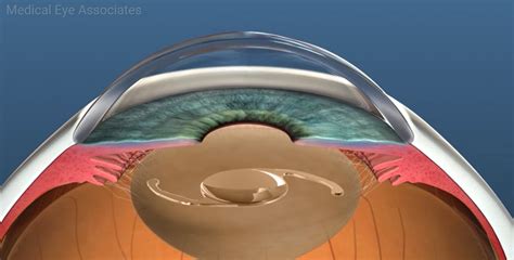 Sultan Agung Eye Center | Manfaat Lensa IOL (Intraocular Lens) dalam ...