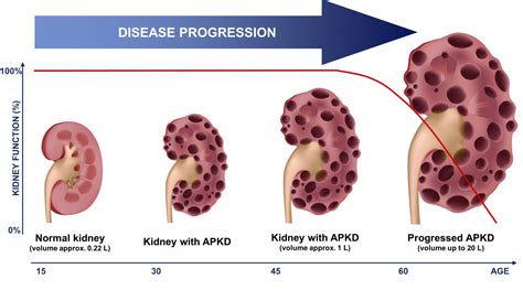 Study Shows Polycystic Kidney Disease Can Be Treated By Ketogenic Diet ...