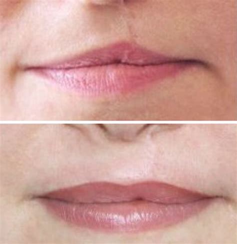 Tattoo Scars, Permanent Makeup, & Cleft Lip Restoration | Wafa Brows