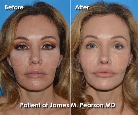 Lip Lift Photos - Before & After - Dr. James Pearson Facial Plastic Surgery