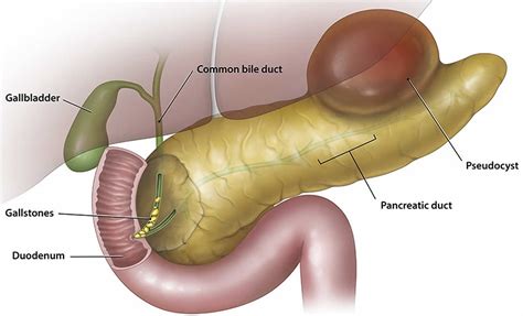 Pancreatic pseudocyst causes, symptoms, diagnosis, treatment & prognosis