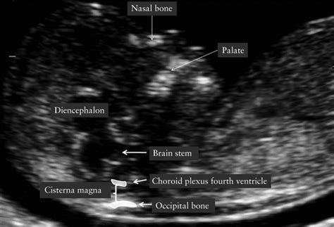 Cisterna Magna Ultrasound