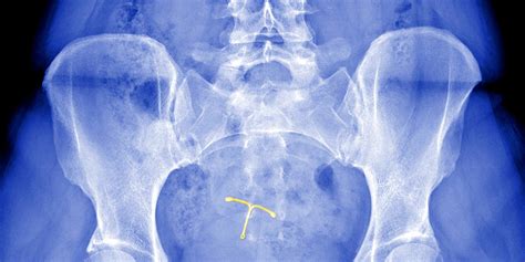 IUD Complications: Ob/Gyns Discuss Expulsion And Perforation | SELF