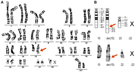 Translocation Down Syndrome Karyotype